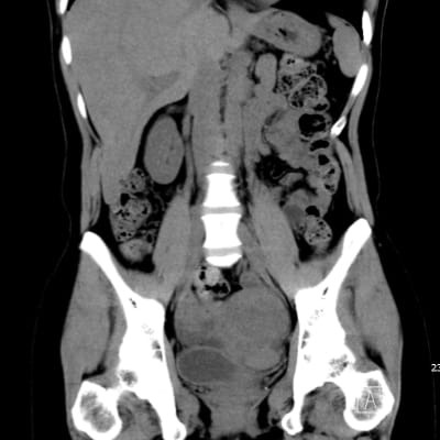 胸部・腹部CT-2
